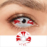 Bloodstained Sclera Lenses