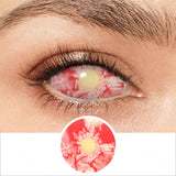 Patient Zero Sclera Lenses