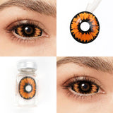 Radioactive Sclera Lenses