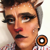 Radioactive Sclera Lenses