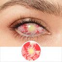 Patient Zero Sclera Lenses